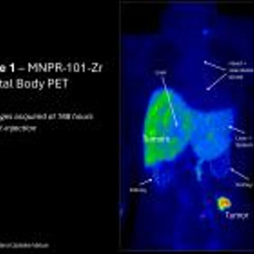 Monopar Announces Positive Early Human Clinical Data Validating the Tumor Targeting Ability of MNPR-101-Zr
