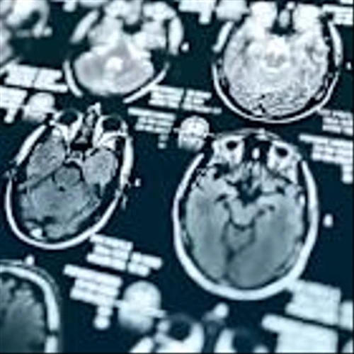 MapLight lines up an IPO in bid to challenge Bristol Myers schizophrenia drug