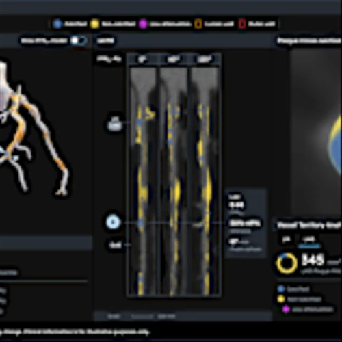 Heartflow Announces FDA 510(k) Clearance and Launch of Next Generation Heartflow Plaque Analysis Platform