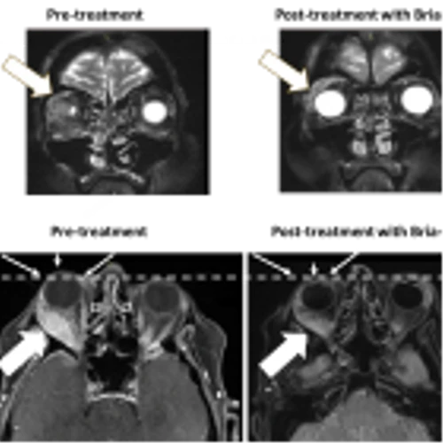 BriaCell Images Confirm Robust Anti-Tumor Activity in Patient with “Eye-Bulging” Metastatic Breast Cancer