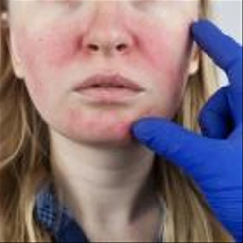 FDA approves Journey Medical’s rosacea treatment Emrosi