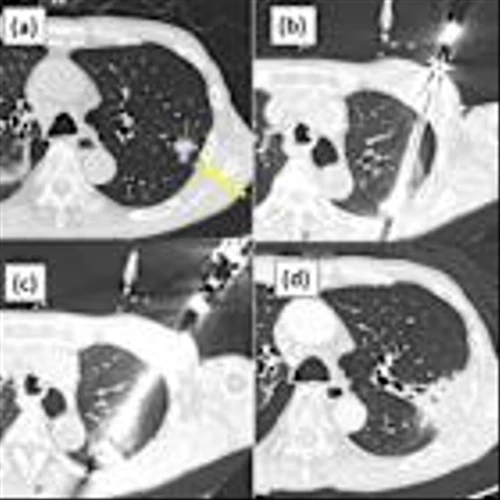 IceCure's Cryoablation System Combined with Radiation Therapy Successfully Treats Non-Small Cell Lung Cancer (NSCLC) with 92% Disease-Specific 5-year Survival