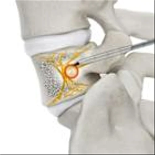 Stryker receives FDA clearance for OptaBlate® BVN Basivertebral Nerve Ablation System