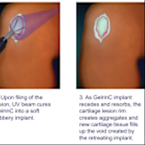 Regentis Biomaterials Commences Trading on NYSE: Set to Transform Cartilage Repair Market with Off-the-Shelf Regenerative Product