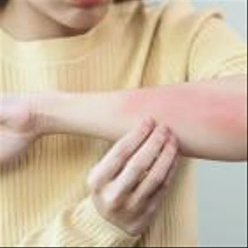 AnaptysBio’s atopic dermatitis trial of BTLA agonist misses endpoints