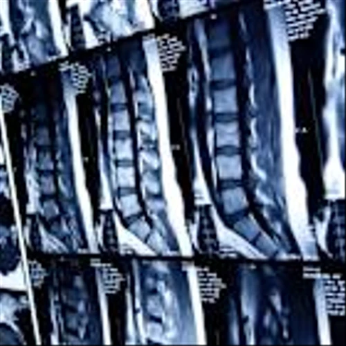 Stryker wins FDA clearance for minimally invasive back pain treatment