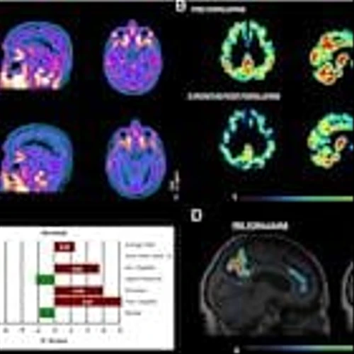 Journal of Clinical Nuclear Medicine Publishes Results of Tiziana’s Nasal Foralumab in Study Treating Moderate Alzheimer's Disease