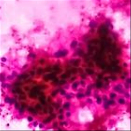 Merck kidney cancer drug succeeds in two large trials