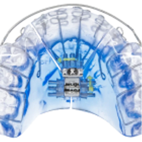 Vivos Therapeutics Receives First Ever FDA 510(k) Clearance for  Oral Device Treatment of Severe Obstructive Sleep Apnea