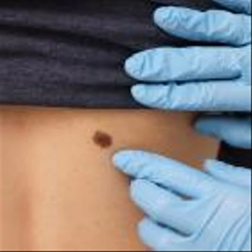 Erasca kicks off Phase III trial for naporafenib combo therapy in melanoma