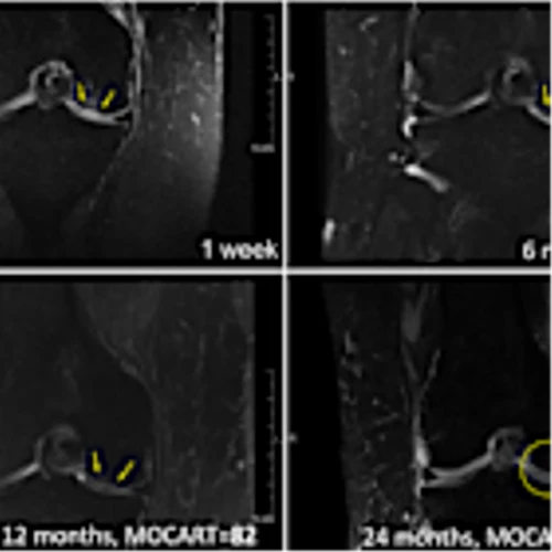 Regentis' GelrinC Demonstrates Breakthrough in Regenerating Native-Like Cartilage Structure in Knee Repair on MRI Results Confirmed Using a Validated, Regulator-Accepted Method