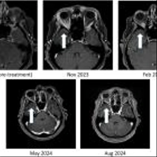 BriaCell Reports 100% Resolution of Brain Metastasis in Breast Cancer Patient with “Eye-Bulging” Tumor