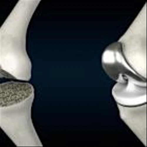 Johnson and Johnson to spin off orthopaedics market