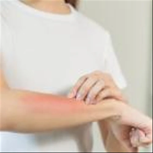 Castle Biosciences reports preliminary data from atopic dermatitis test study