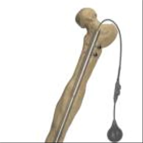 Orthofix Announces 510(k) Clearance and First Implant of Fitbone Transport and Lengthening System