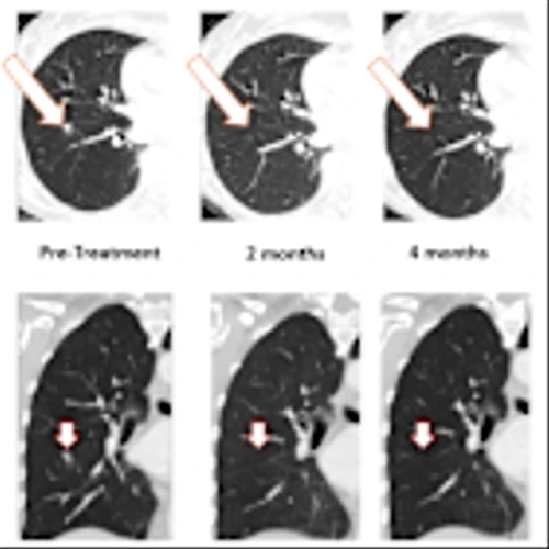 BriaCell Confirms 100% Resolution of Lung Metastasis with Bria-OTS™