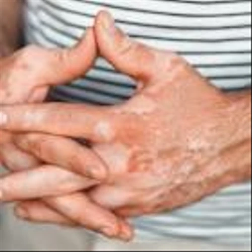 AbbVie posts another win for Rinvoq in Phase III vitiligo trials