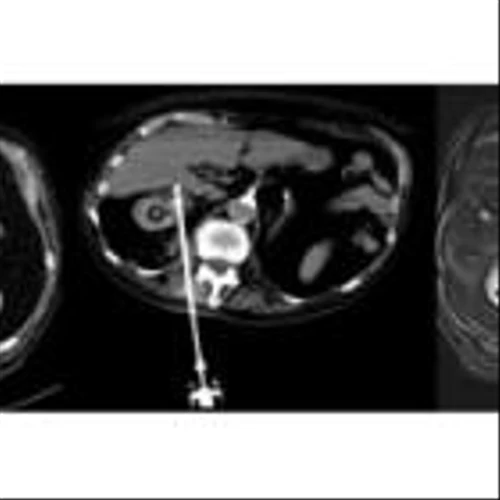 IceCure System Successfully Treated Kidney Cancer Tumor with 92% Disease-Free Survival Rate and 100% Secondary Local Control Rate