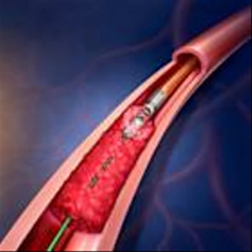BD to Initiate Real-World Patient Data Registry for the Rotarex™ Atherectomy System in Treatment of Peripheral Artery Disease