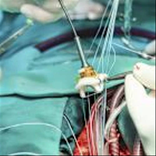 Edwards Lifesciences’ TAVR growth continues as global demand rises