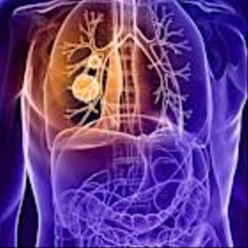 FDA clears Nuvation lung cancer drug, setting up battle with Bristol Myers and Roche