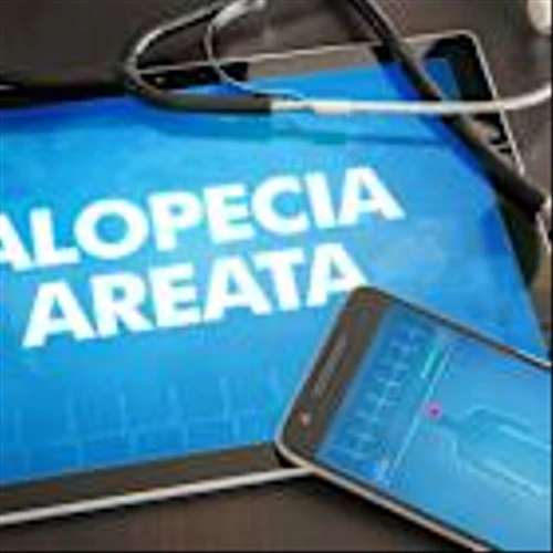 AbbVie’s upadacitinib raises the bar for alopecia areata