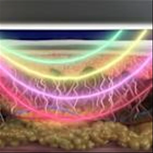IR-MED Reports Positive Interim Results from U.S. Clinical Study of PressureSafe(TM) for Pressure Injury Assessment Across Diverse Skin Tones