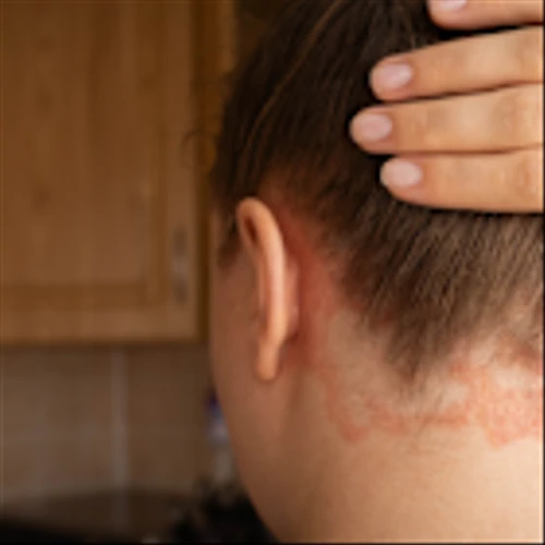 J&J and Protagonist’s oral plaque psoriasis drug bests BMS’ Sotyktu