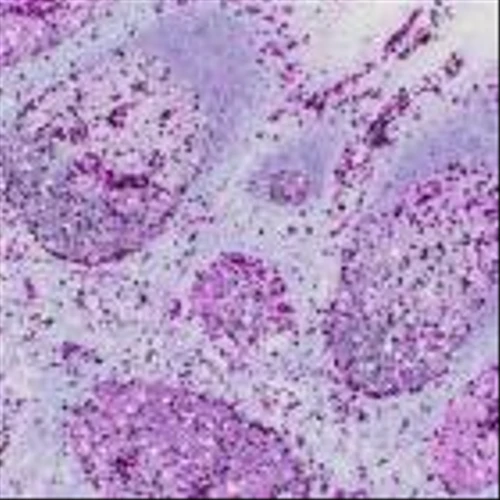 Roche receives FDA clearance for new, highly-sensitive test to aid clinicians in diagnosing B-cell lymphoma