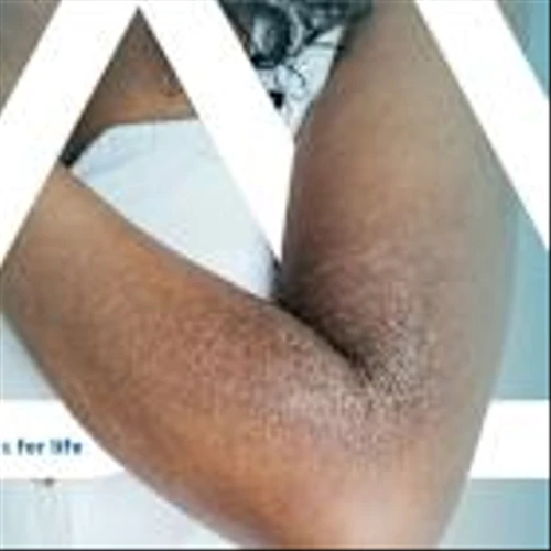 How Apogee, Up 20%, Plans To Take On Rival Regeneron's Eczema Drug