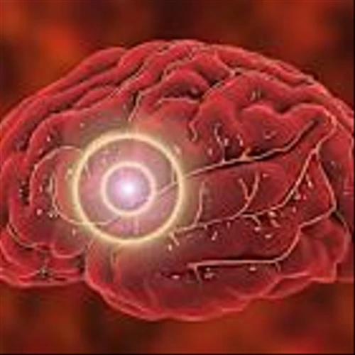 Partnership between Siemens Healthineers and Stryker aims to redefine neurovascular intervention with robotics