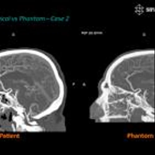 Stratasys and Siemens Healthineers Bring a New Era for Medical Imaging Research With Patient-Specific 3D-Printed Phantoms