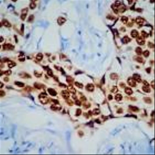 Full Arvinas, Pfizer data confirm potential, limits of ‘Protac’ drug in breast cancer
