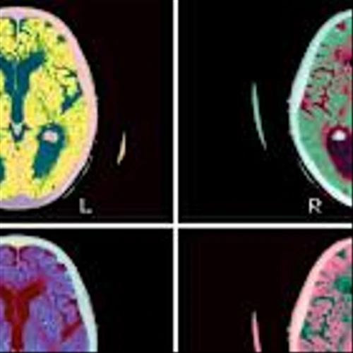 This Drugmaker Is Too Cheap to Ignore. Why Bristol Is a Buy.