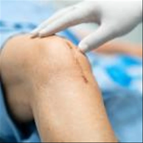 Stryker may be able to displace Zimmer in US knee reconstruction market