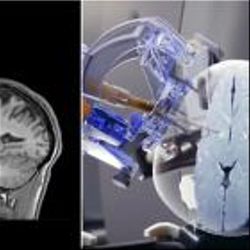 ClearPoint Neuro Congratulates its Partner PTC Therapeutics on Completion of Biologics License Application Submission to FDA for Upstaza™ as a Treatment for AADC Deficiency