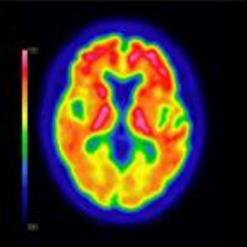 FDA Approves Expanded Indications for GE HealthCare’s Vizamyl PET Imaging Agent for Beta Amyloid Detection, Enabling More Precise Care for Alzheimer’s Patients