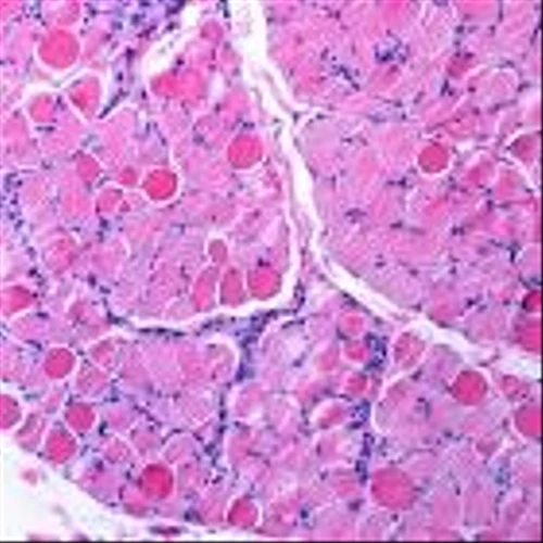 Solid says early data suggest ‘differentiated’ Duchenne gene therapy
