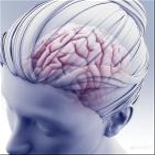 Surgical stroke initiative targets deadliest brain bleeds