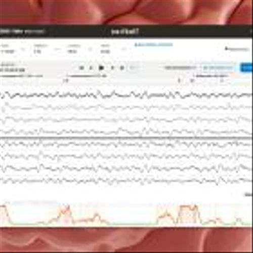 CeriBell IPO: Stock price soars as AI brain-monitoring headband maker debuts on Nasdaq