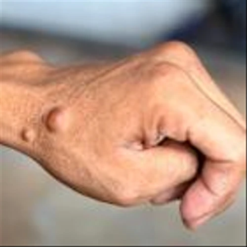 Pasithea to commence Phase I/Ib trial of neurofibromatosis type 1 therapy