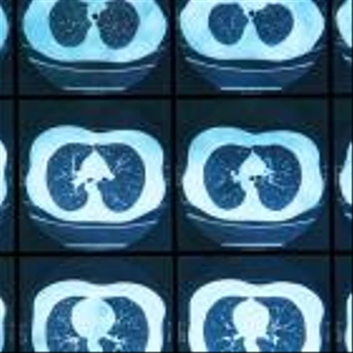 TIGIT drug from iTeos shrinks lung tumors in trial