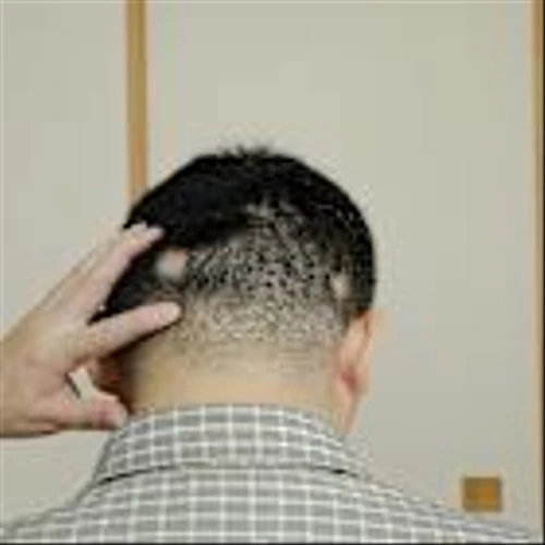 Nektar completes enrolment in trial of rezpegaldesleukin for alopecia areata