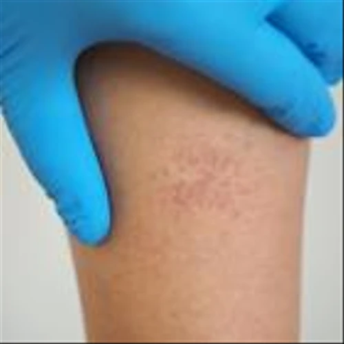 Novartis scores again with third ianalumab Phase III victory