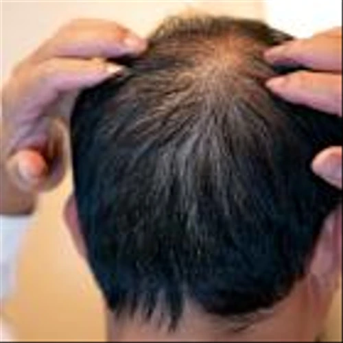 No Revenue? No Problem. Biotech Targeting Hair Loss Doubles in Stock IPO.