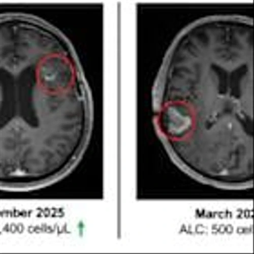 ImmunityBio Reports Median Overall Survival Not Yet Reached and Lymphopenia Reversed in Recurrent Glioblastoma Patients Receiving ANKTIVA® Plus CAR-NK, Chemo-Free Therapy