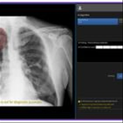 GE HealthCare Expands On-Device Triage Capabilities of Critical Care Suite with FDA Clearance of Algorithm for Pneumothorax Detection, Notification, Triage and Diagnosis