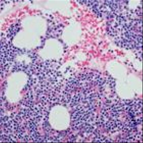 Bristol Myers says next-gen blood cancer drug hits goal in key study