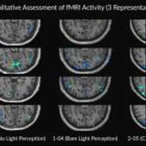 Kiora Pharmaceuticals Reports Additional Clinical Data for KIO-301 Showing a Statistically Significant Increase in Brain Activity in the Visual Cortex in Patients with Retinitis Pigmentosa