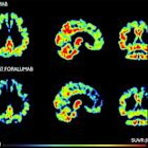 Tiziana Life Sciences Announces Significant Reduction in Microglia Activation in PET Scan of Moderate Alzheimer's Patient Treated with Intranasal Foralumab